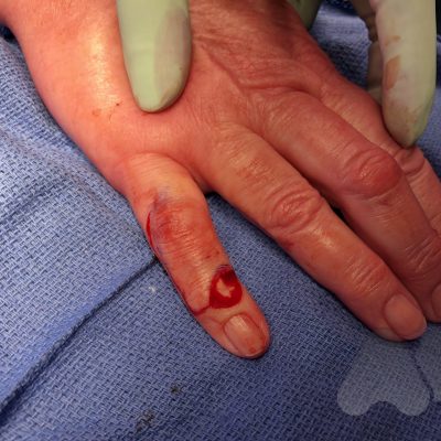 Large mucous cyst with skin excision and local skin rotation flap