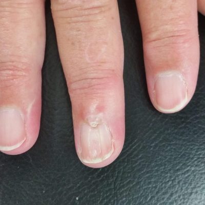 Small mucous cyst with nail ridging