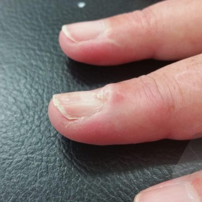 Mucous cyst with nail change 2 AM