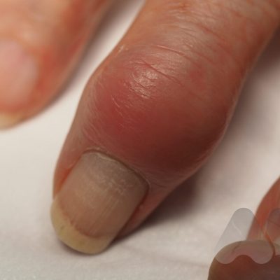 DIP joint arthritis