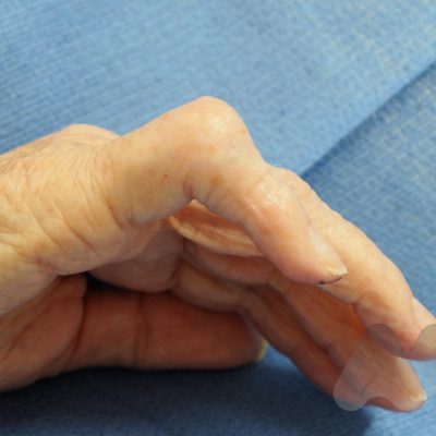 Volar PIPJ dislocation