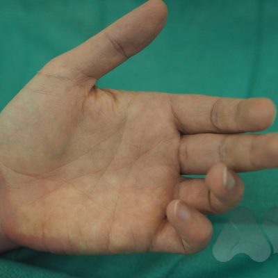 Ulna neuropathy from cubital tunnel syndrome