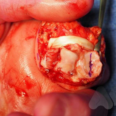 PIPJ dorsal fracture dislocation - Base of proximal phalanx fracture >60%