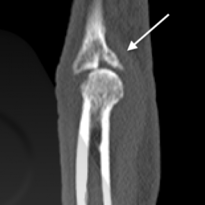 PIPJ dorsal fracture dislocation