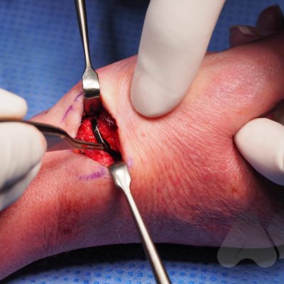 Thumb CMC joint interposition joint replacement (Pyrocardan)