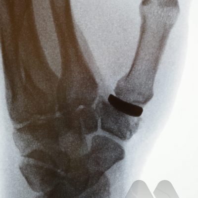 Thumb CMC joint interposition joint replacement (Pyrocardan)