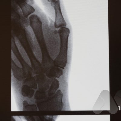 Thumb CMC joint interposition joint replacement (Pyrocardan)