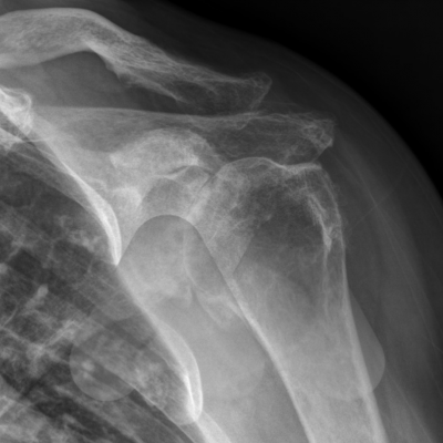 Primary shoulder osteoarthritis