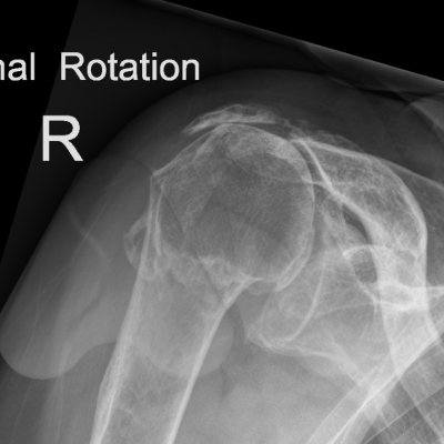 Rotator cuff arthropathy