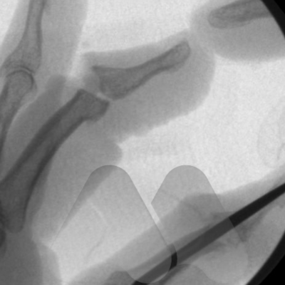 DIP joint replacement