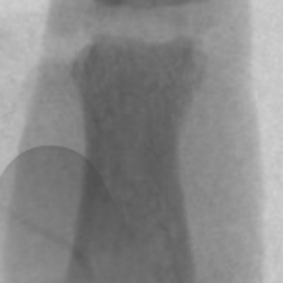 DIPJ replacement for osteoarthritis