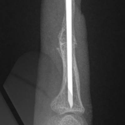 DIP joint fusion