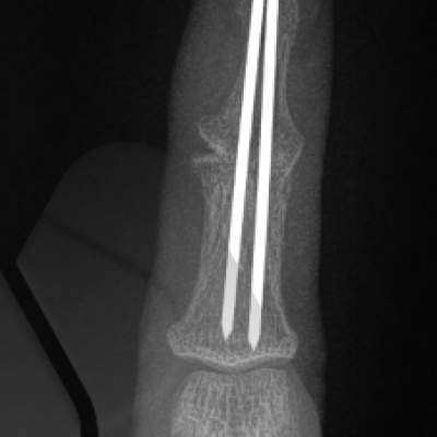 DIP joint fusion