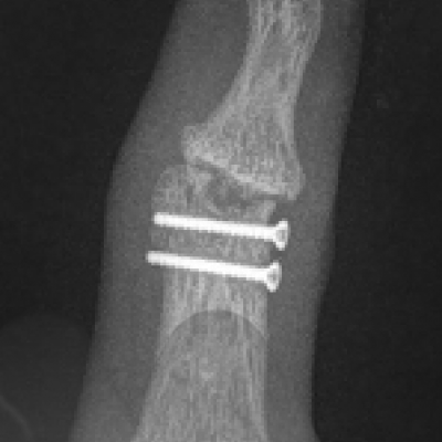 Osteonecrosis and arthritis DIP joint