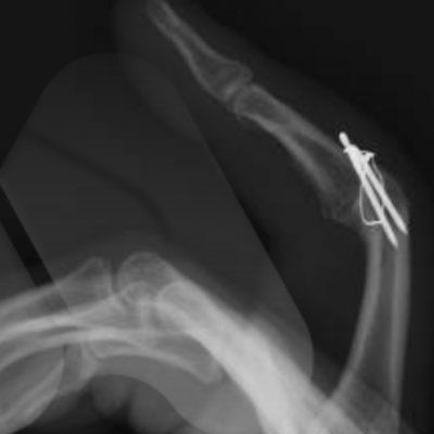 Index finger PIP joint fusion