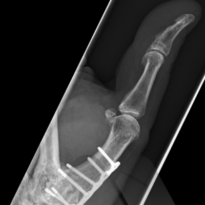 Thumb CMC fusion