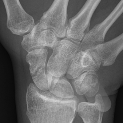 Scaphoid waist fracture