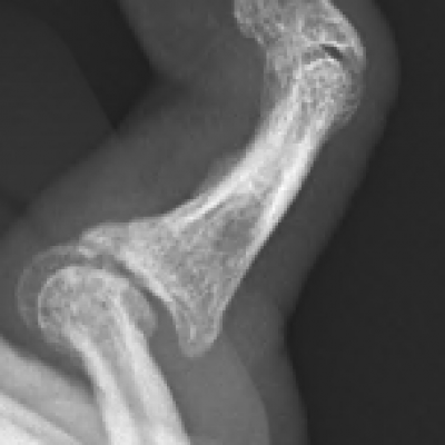 PIP joint post traumatic osteoarthritis