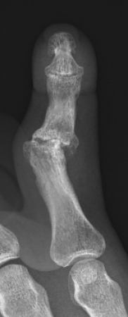 PIP joint post traumatic osteoarthritis PIP joint post traumatic osteoarthritis