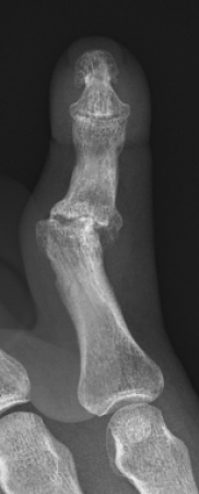 PIP joint post traumatic osteoarthritis