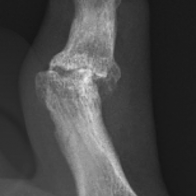 PIP joint post traumatic osteoarthritis
