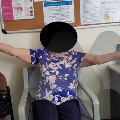 Movement after total elbow replacement