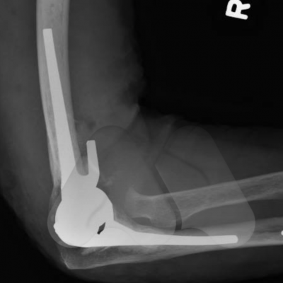 Total elbow replacement