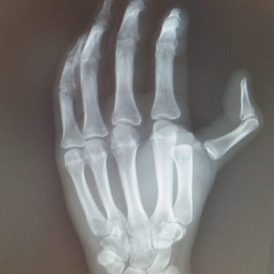 Thumb MP dislocation XR 1 AM
