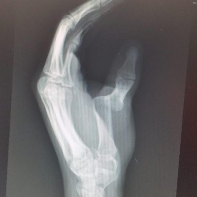 Thumb MP dislocation XR 2 AM