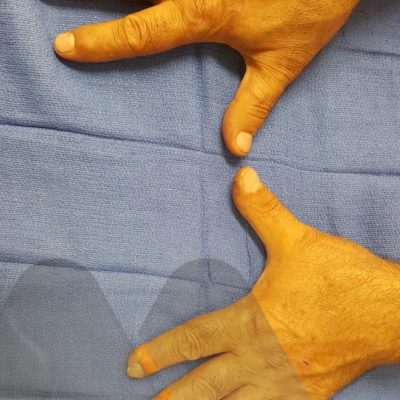 Right thumb CMC fusion and left thumb CMC arthritis