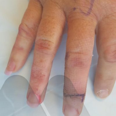 Rotational flap for large mucous cyst