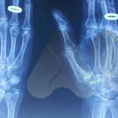 Thumb CMC joint arthritis