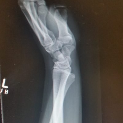 Volar DRUJ dislocation 1 AM