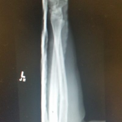 Volar DRUJ dislocation 2 AM