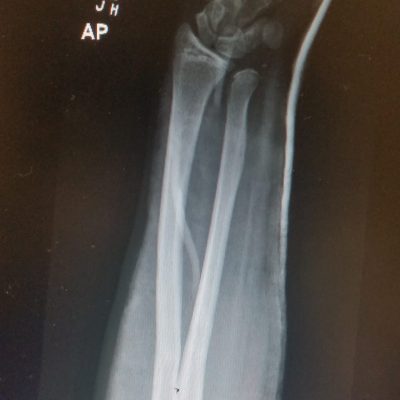 Volar DRUJ dislocation 3 AM