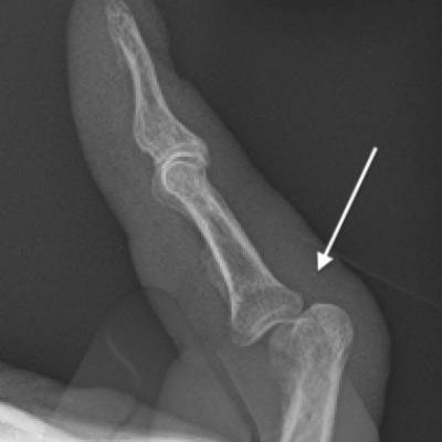 Volar PIPJ dislocation