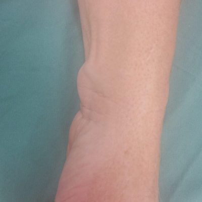 Volar wrist ganglion 1 AM