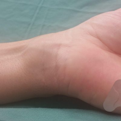 Volar wrist ganglion 5 AM